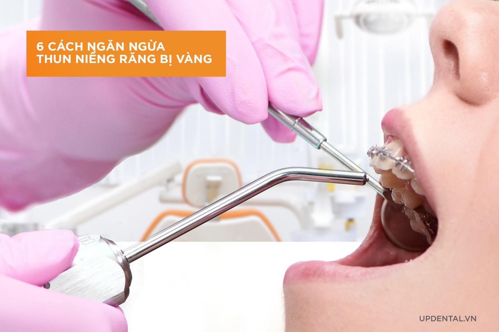 Cách ngăn ngừa thun niềng răng bị vàng