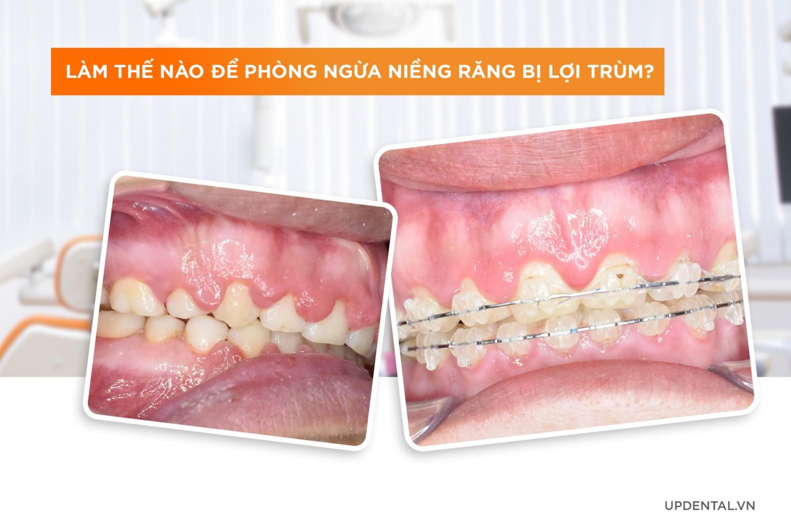 Cách ngừa niềng răng bị lợi trùm