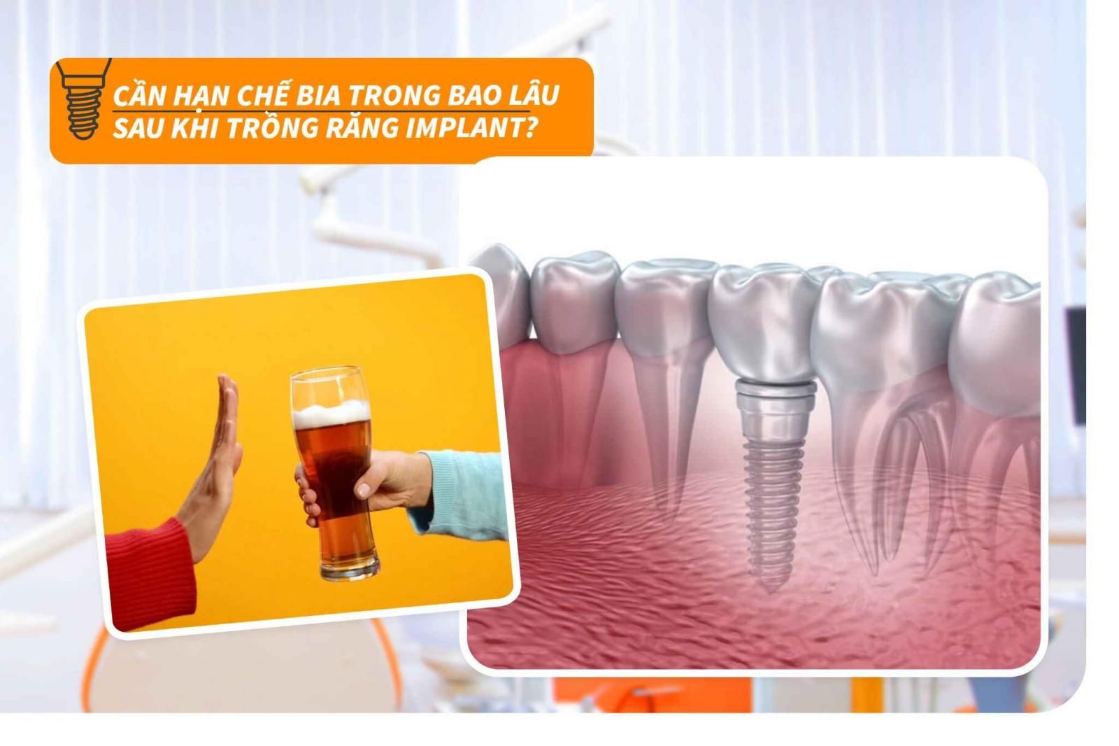 Cần hạn chế bia bao lâu sau khi trồng răng Implant?