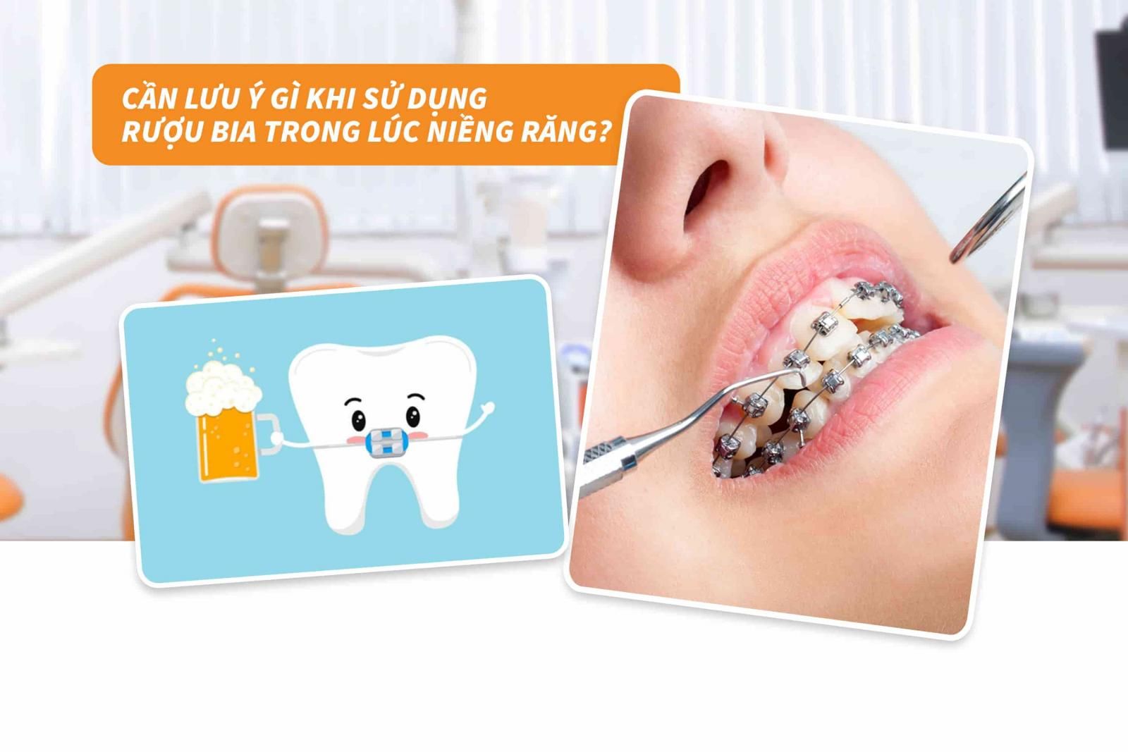 Lưu ý gì khi sử dụng rượu bia trong lúc niềng răng