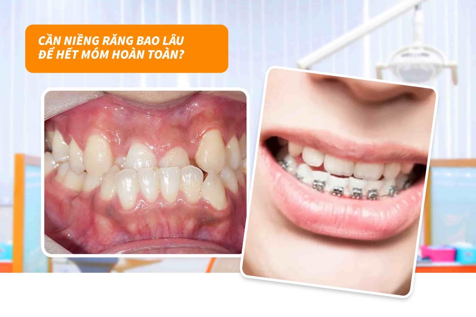 Cần niềng răng bao lâu để hết móm hoàn toàn?