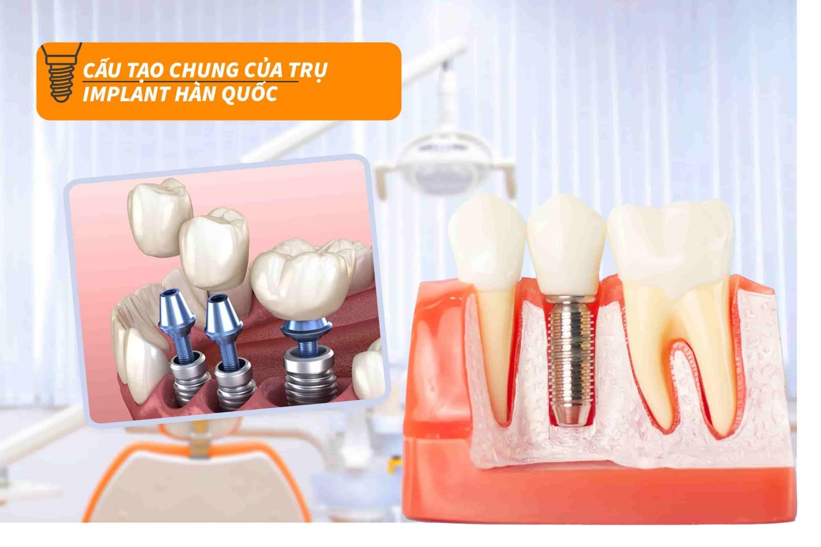 Cấu tạo chung của trụ Implant Hàn Quốc