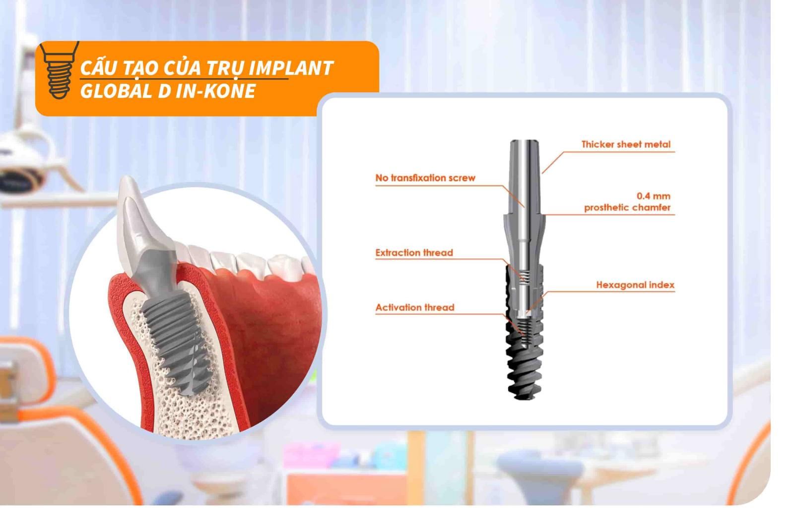 Cấu tạo của trụ Implant Global D In-Kone