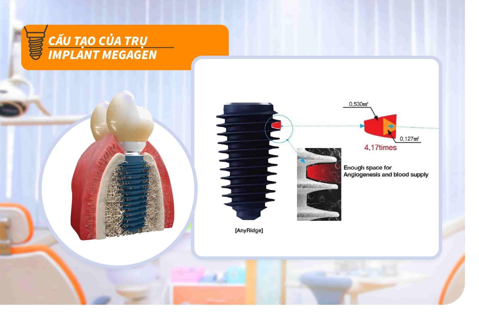 Cấu tạo của trụ Implant Megagen