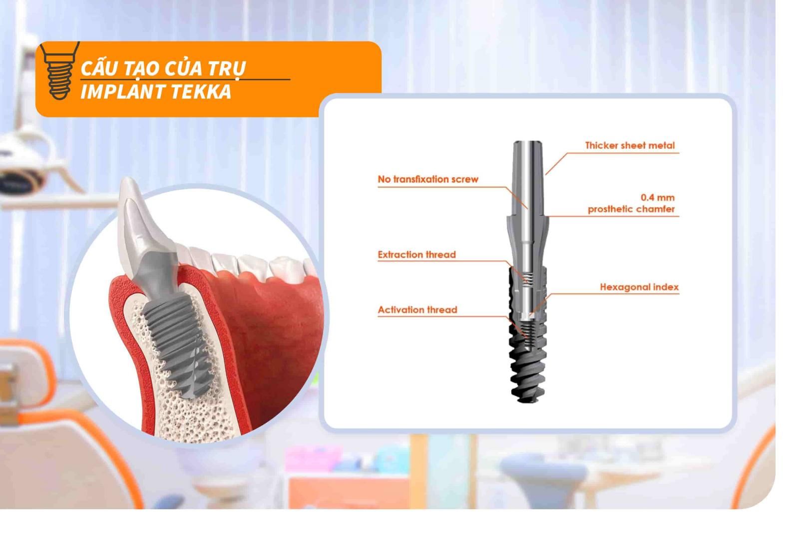 Cấu tạo của trụ Implant Tekka