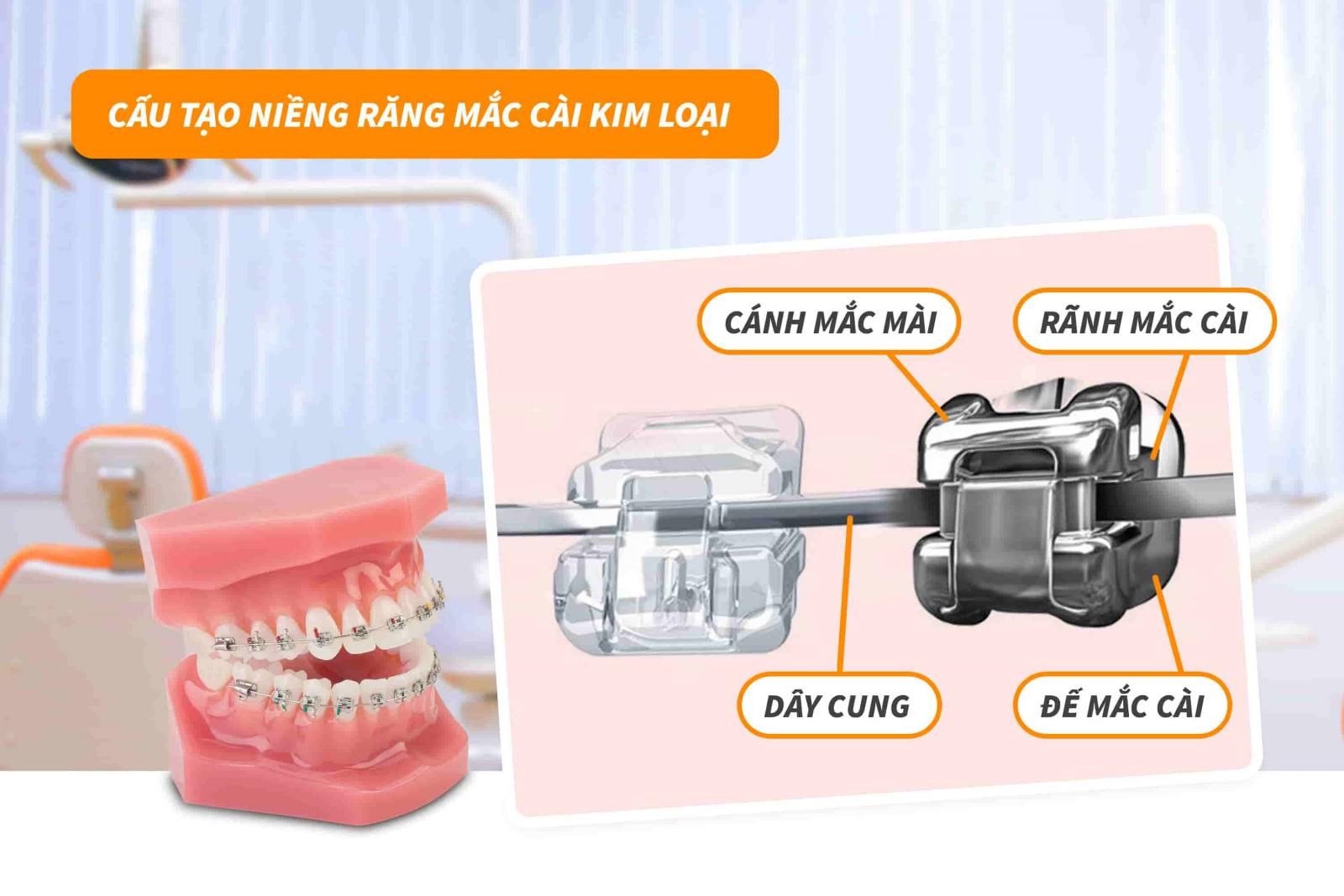 Cấu tạo niềng răng mắc cài kim loại