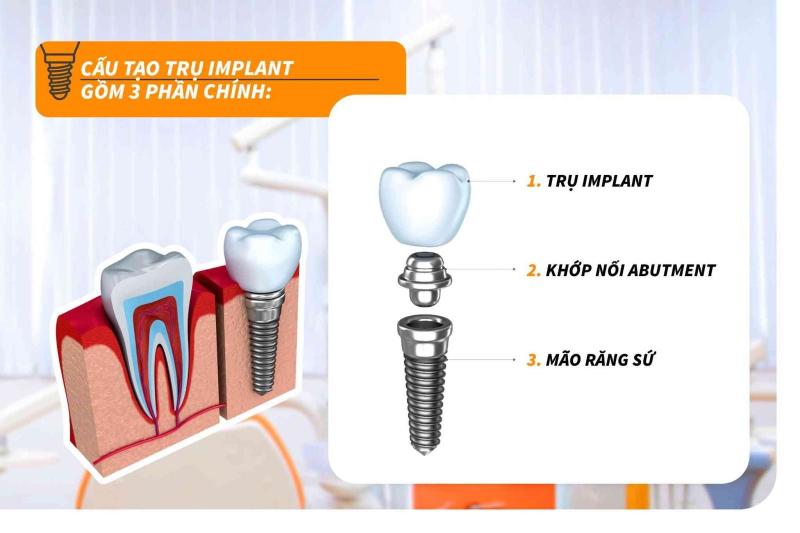 Cấu tạo trụ Implant