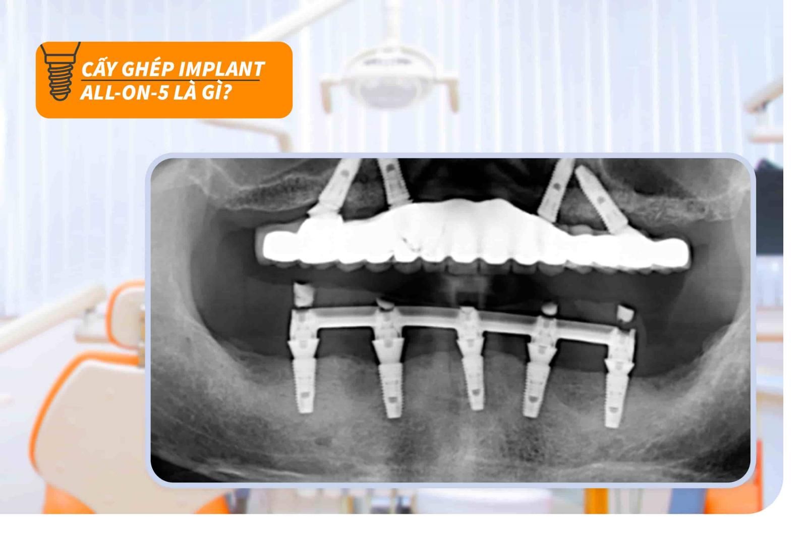 Cấy ghép Implant all-on-5 là gì?