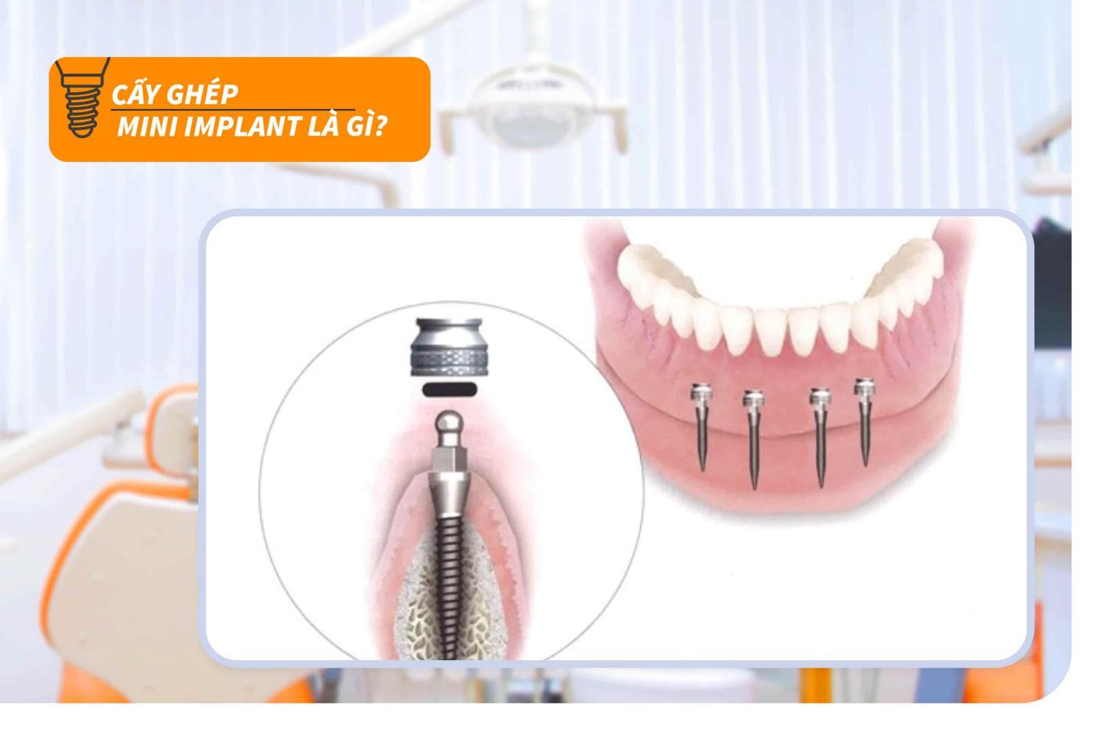 Cấy ghép mini Implant là gì?