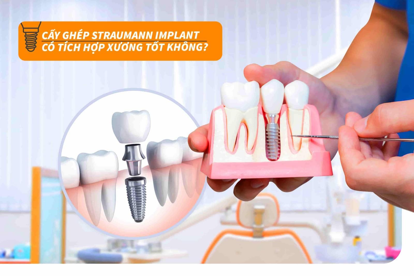 Cấy ghép trụ Implant Straumann có tích hợp xương tốt không?