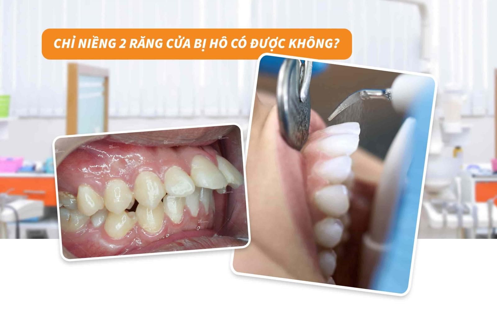 Chỉ niềng 2 răng cửa bị hô có được không? 