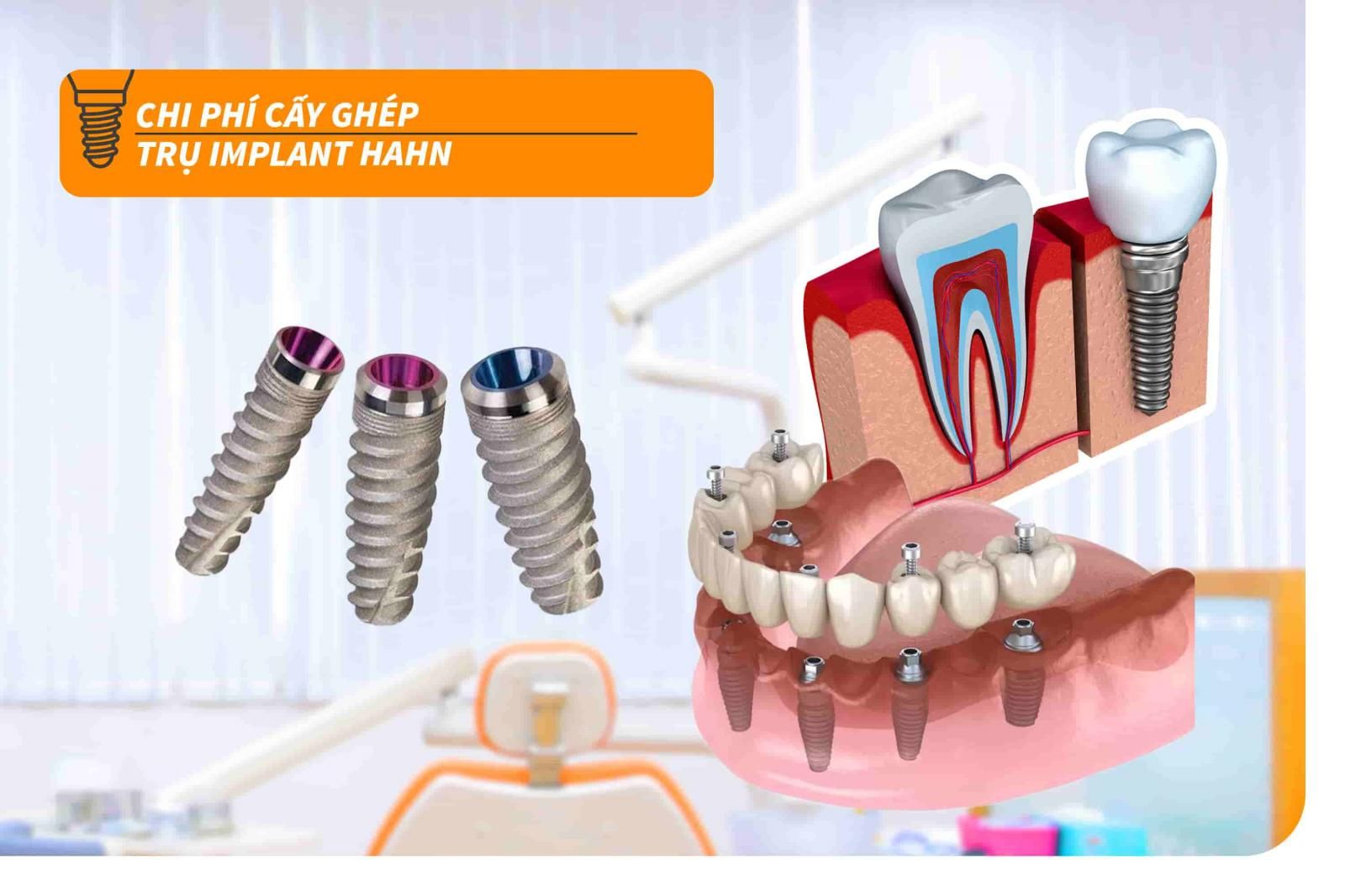 Chi phí cấy ghép trụ Implant Hahn