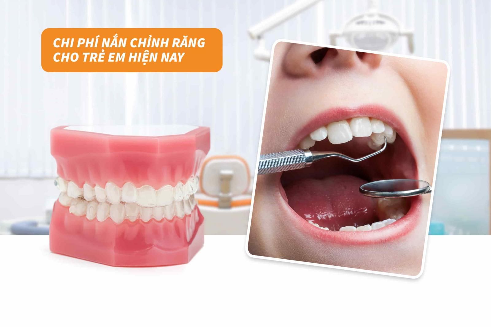 Chi phí nắn chỉnh răng cho trẻ em hiện nay