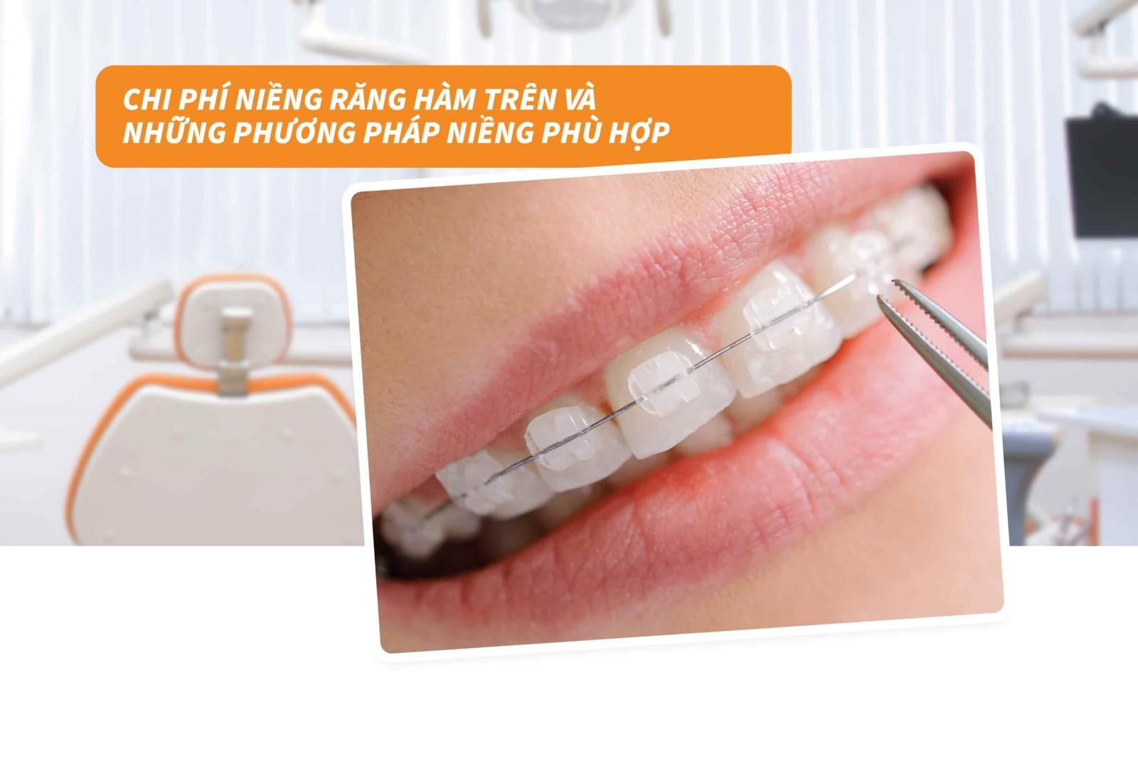 Chi phí niềng răng hàm trên và những phương pháp niềng phù hợp