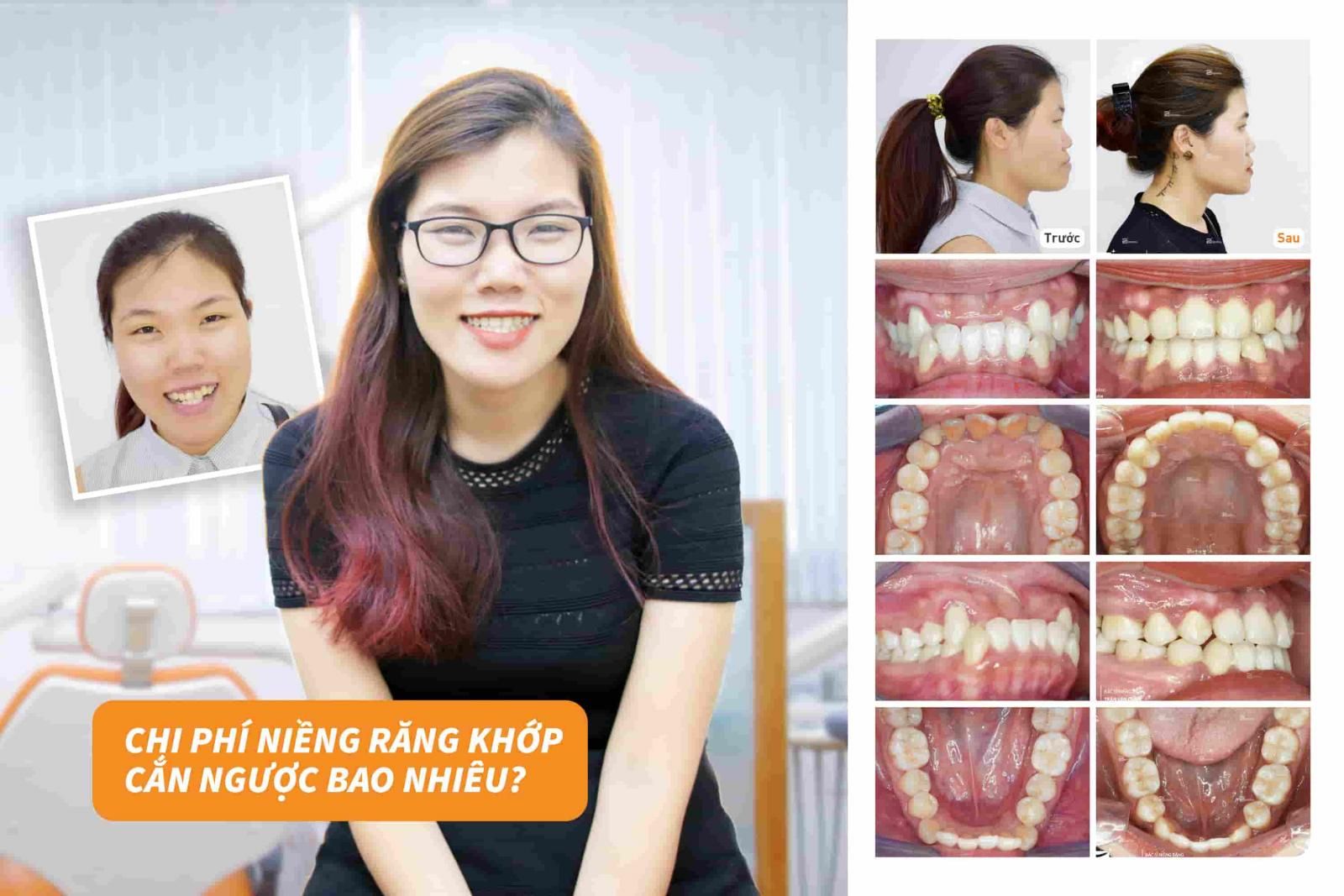 Chi phí niềng răng khớp cắn ngược bao nhiêu? 