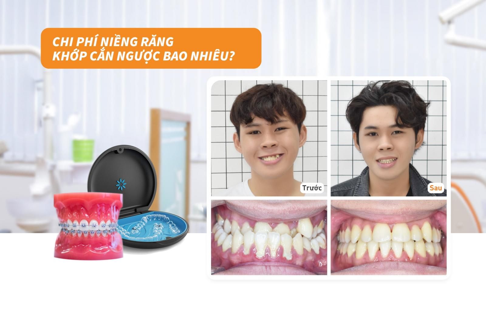 Chi phí niềng răng khớp cắn ngược bao nhiêu