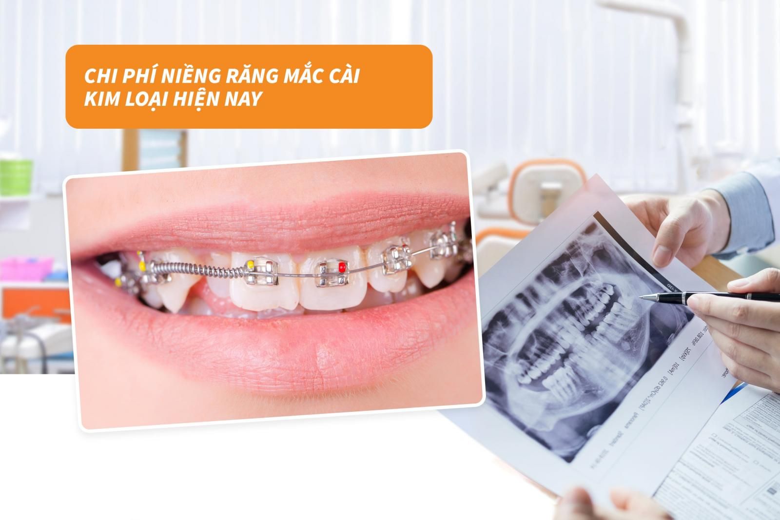 Chi phí niềng răng mắc cài kim loại hiện nay