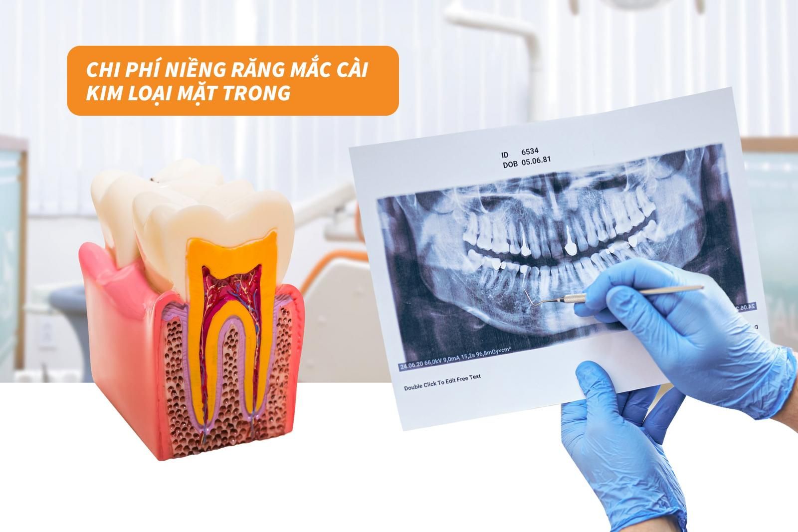 Chi phí niềng răng mắc cài kim loại mặt trong