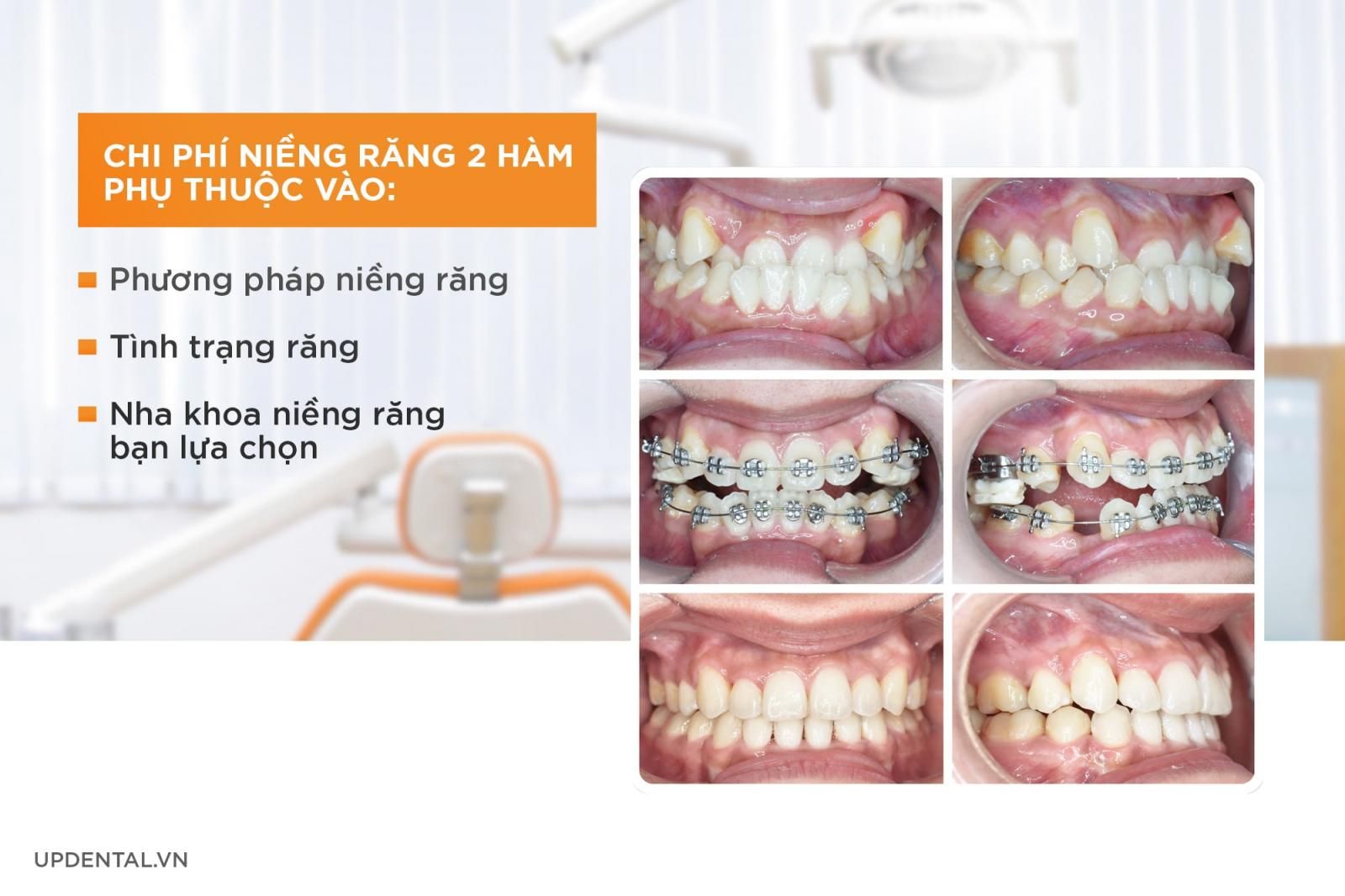 Chi phí niềng răng phụ thuộc vào yếu tố nào