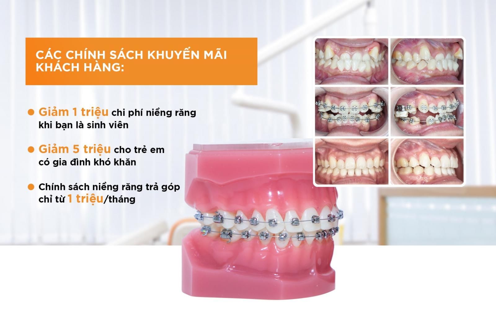 Chính sách ưu đãi tại Up Dental