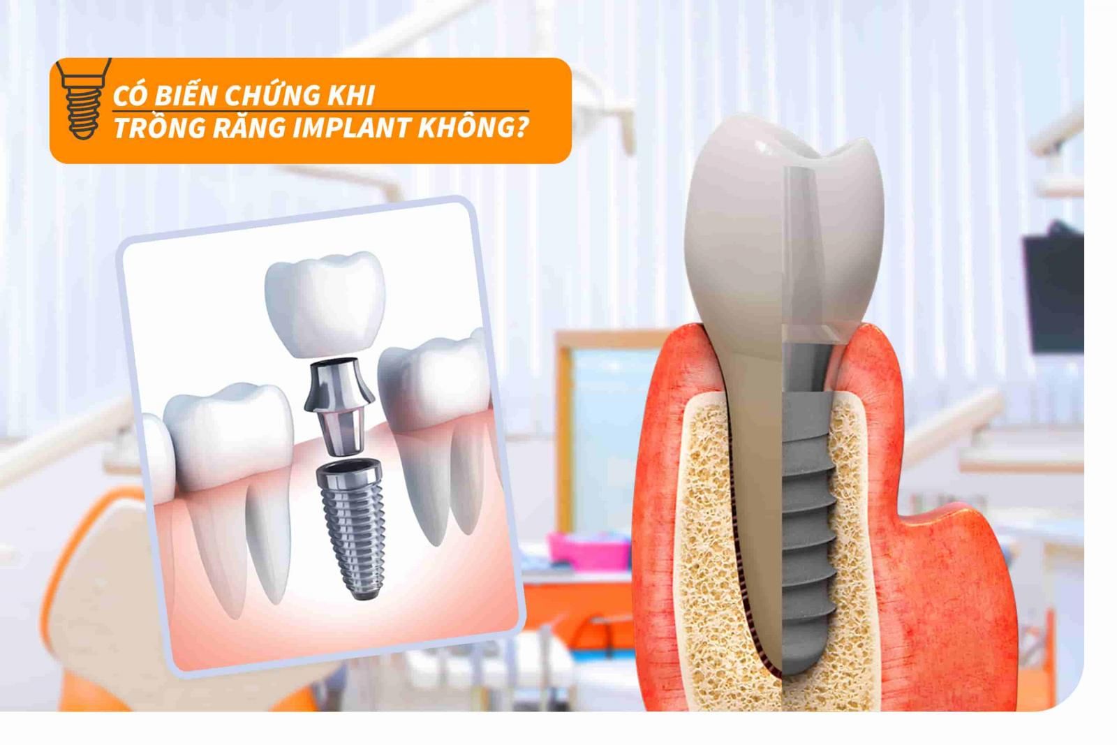 Có biến chứng khi trồng răng Implant không?