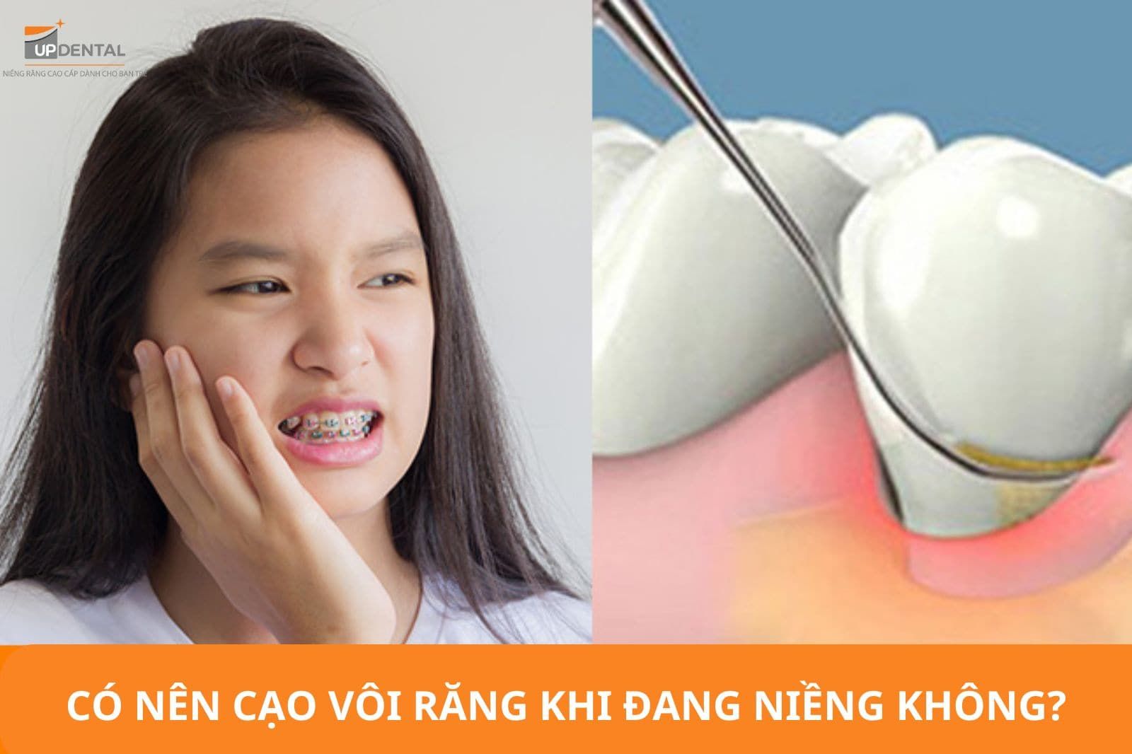 Có nên cạo vôi răng khi niềng răng không?