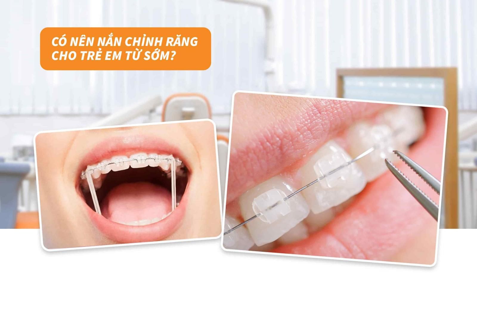 Có nên nắn chỉnh răng cho trẻ em từ sớm? 