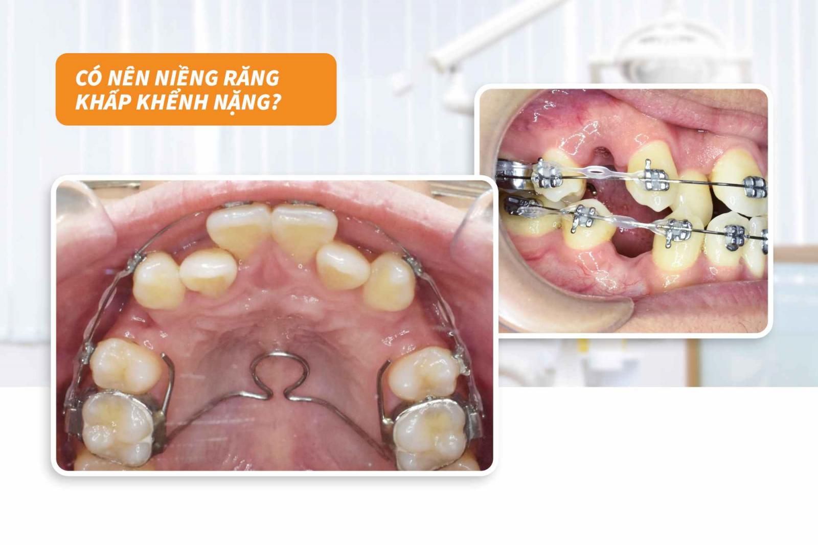 Có nên niềng răng khấp khểnh nặng không? 