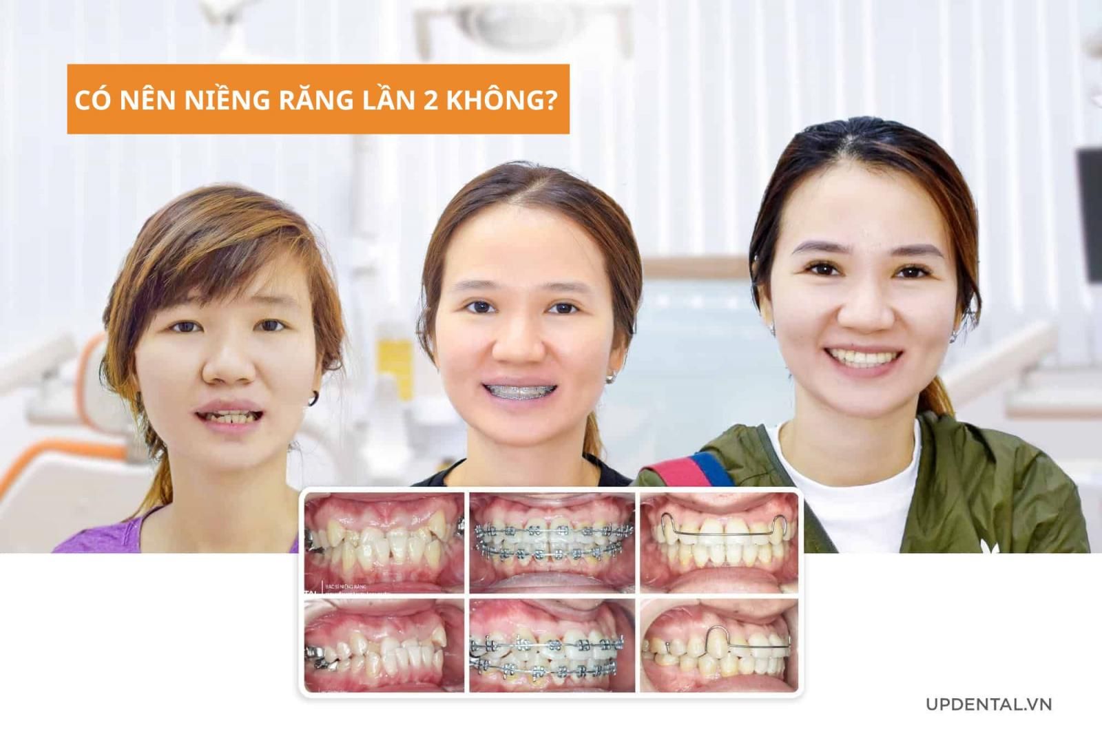 Có nên niềng răng lần 2 không?