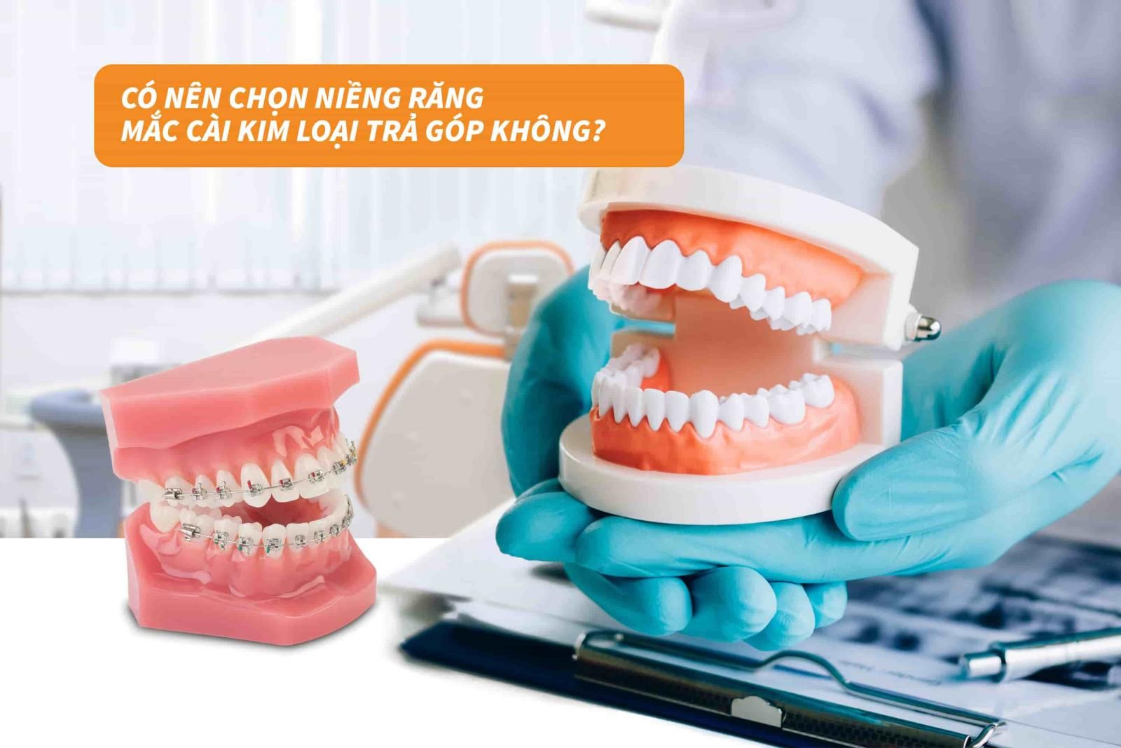 Có nên chọn niềng răng mắc cài kim loại trả góp không?