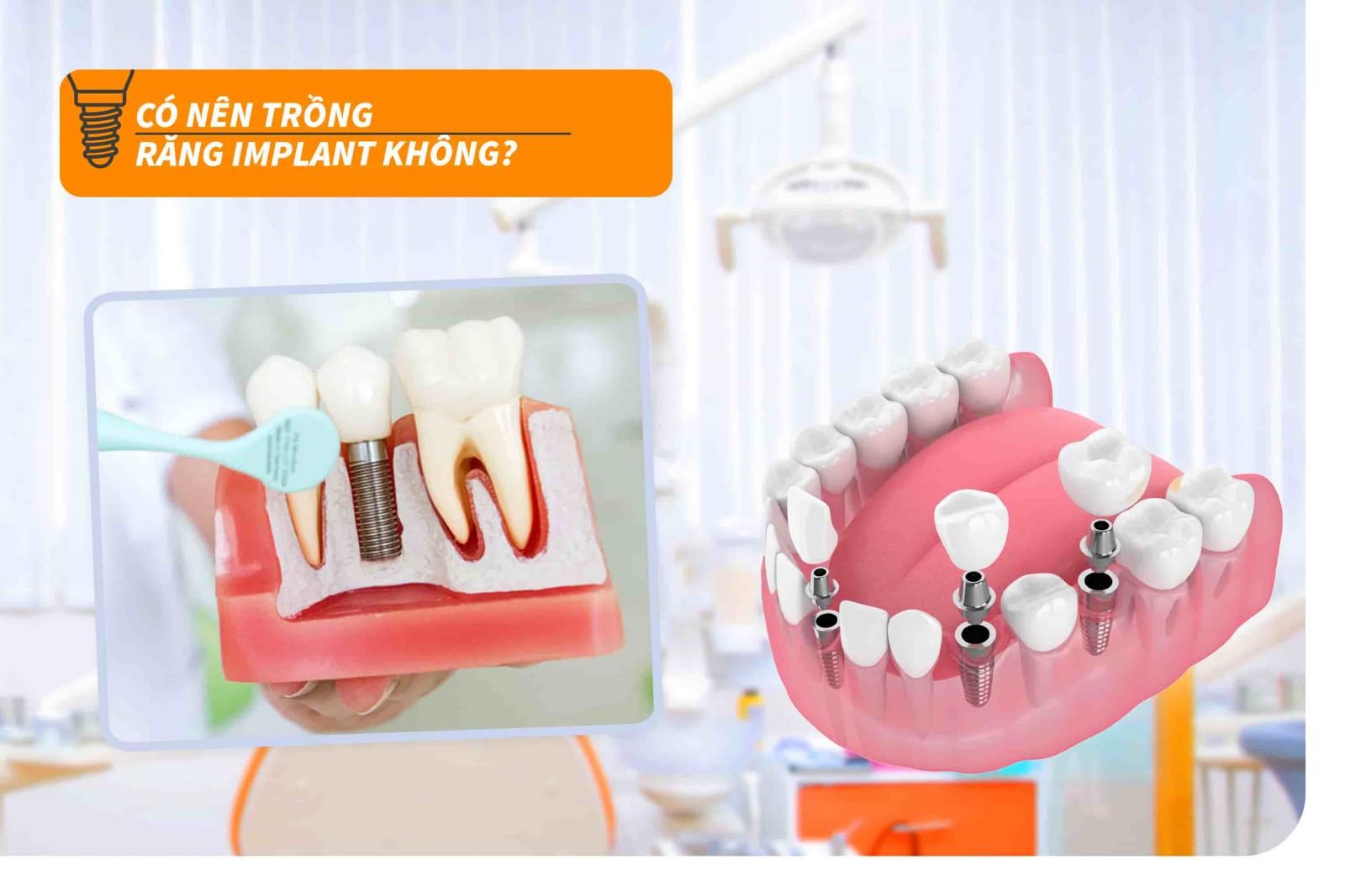 Có nên trồng răng Implant không?