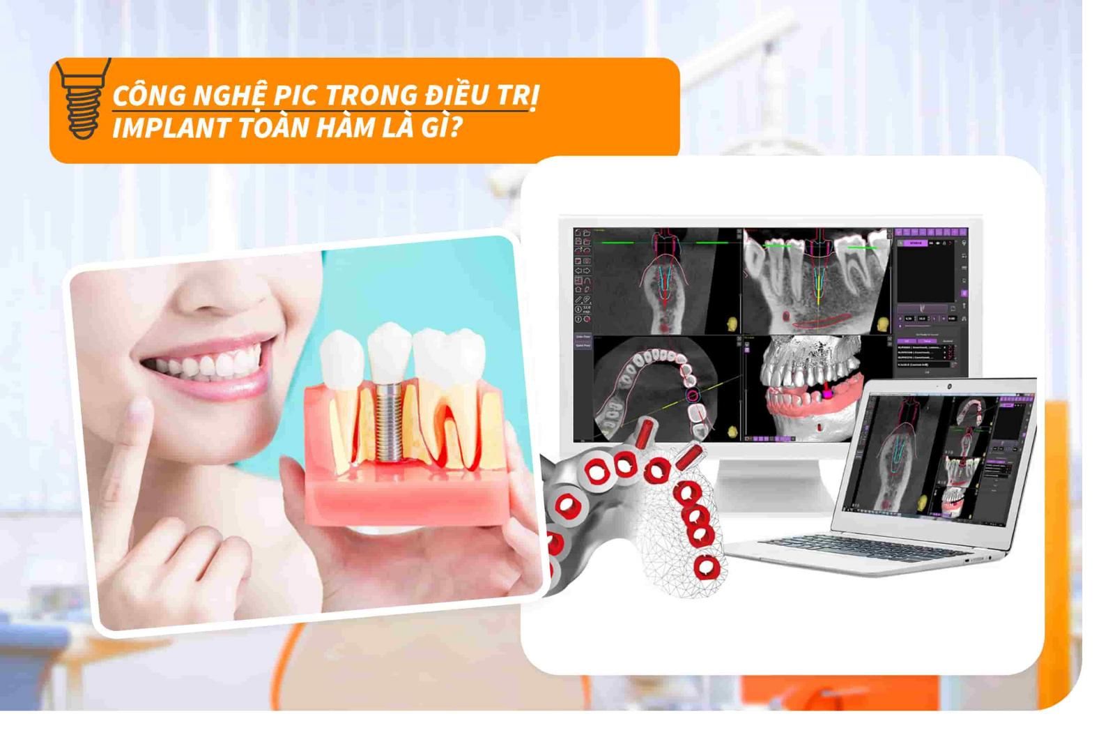 Công nghệ PIC trong điều trị Implant toàn hàm là gì?