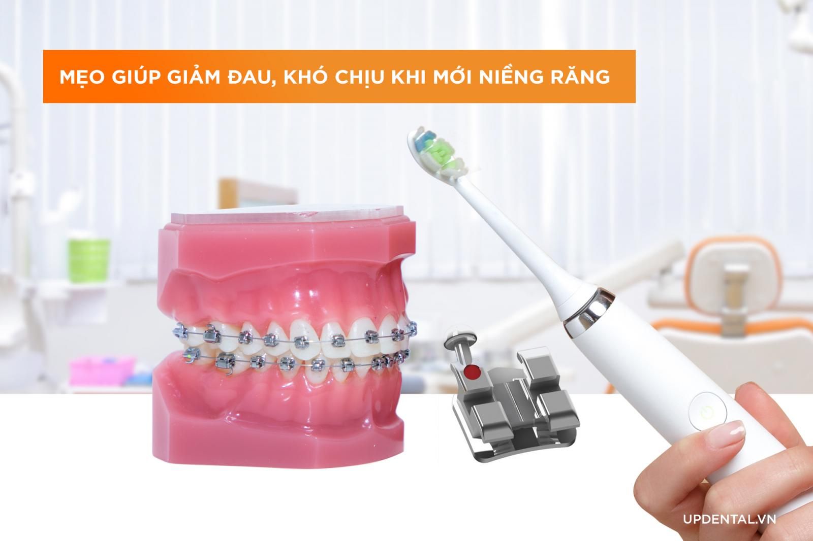 mẹo giảm đau khi niềng răng