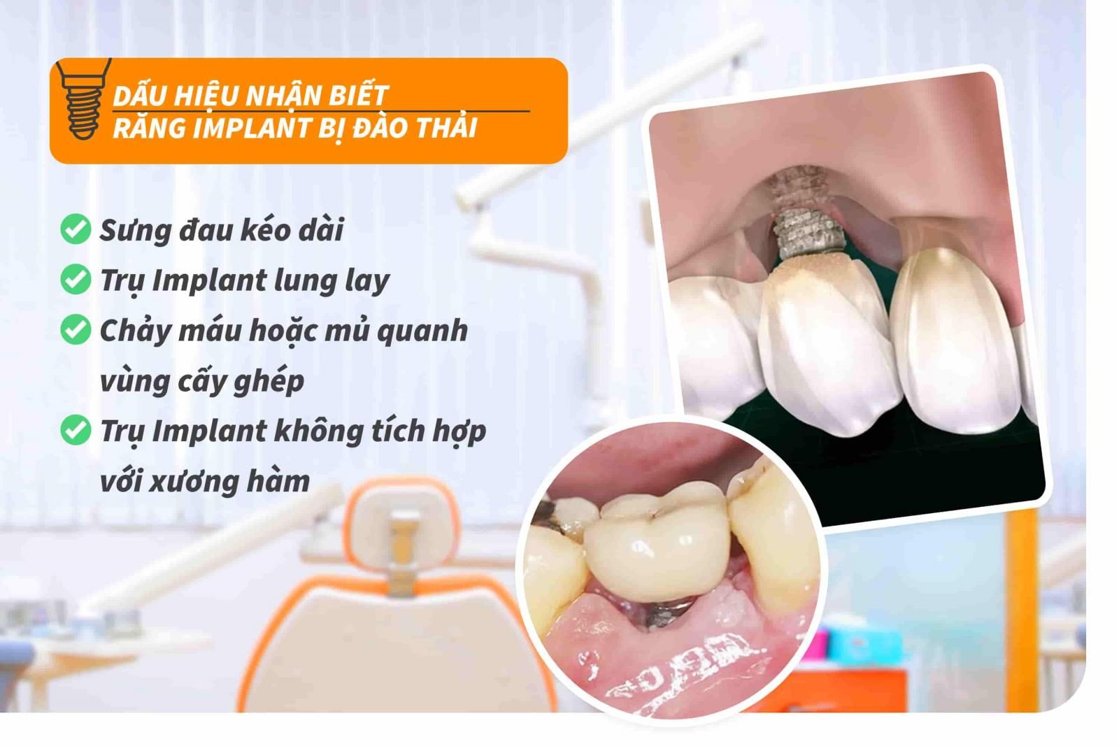 Dấu hiệu nhận biết răng Implant bị đào thải