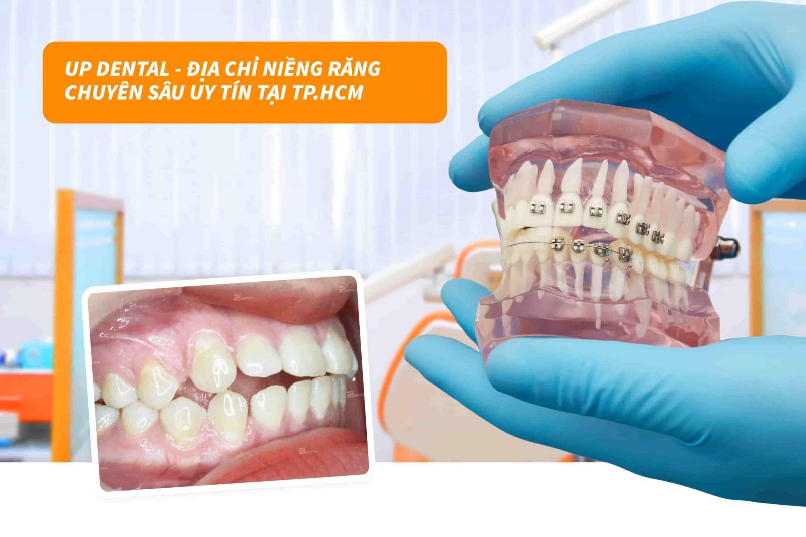 Up Dental - Địa chỉ niềng răng chuyên sâu uy tín tại TP.HCM 