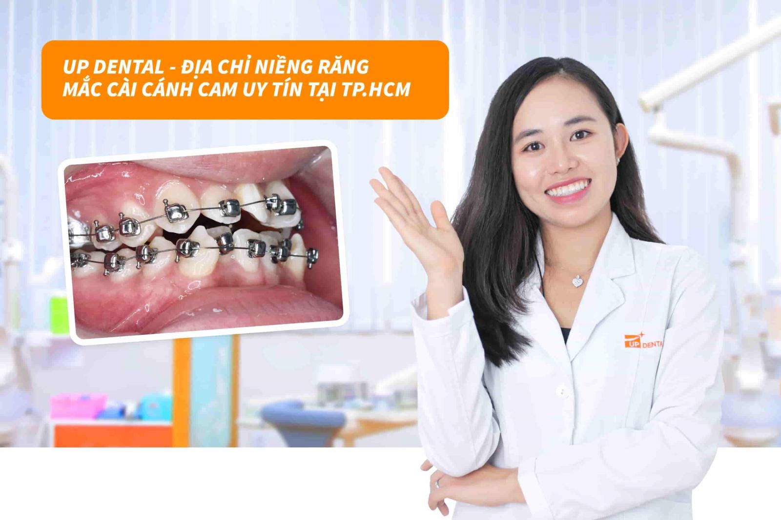 Up Dental địa chỉ niềng răng mắc cài cánh cam uy tín tại TP.HCM