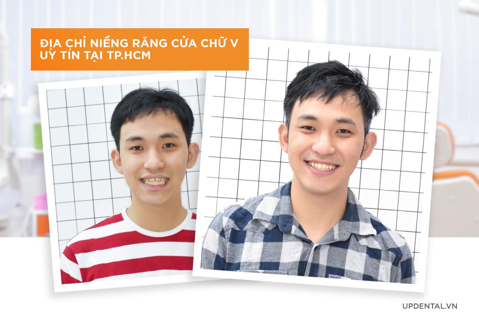 Địa chỉ niềng răng cửa chữ V uy tín