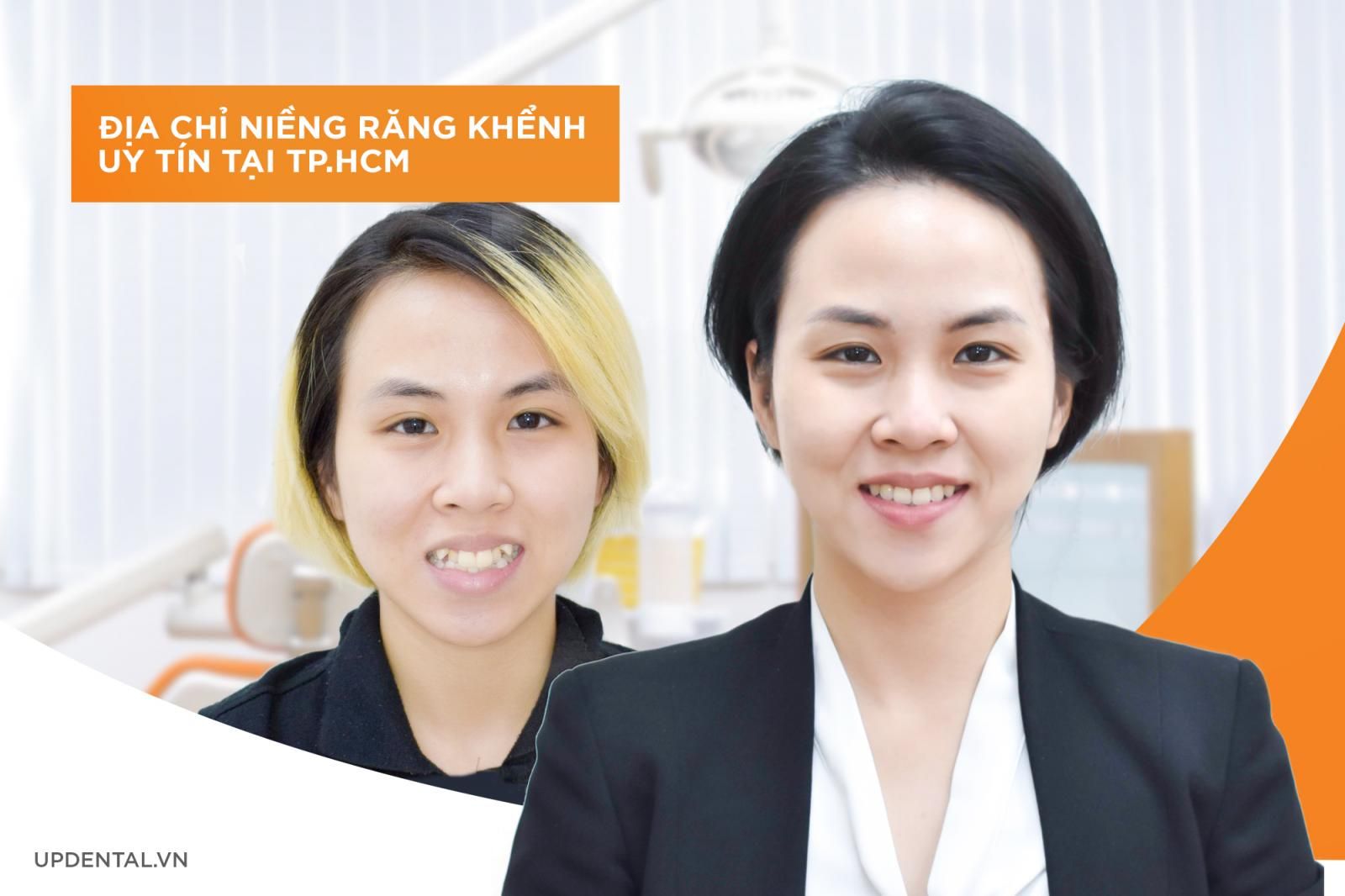 Địa chỉ niềng răng khểnh uy tín