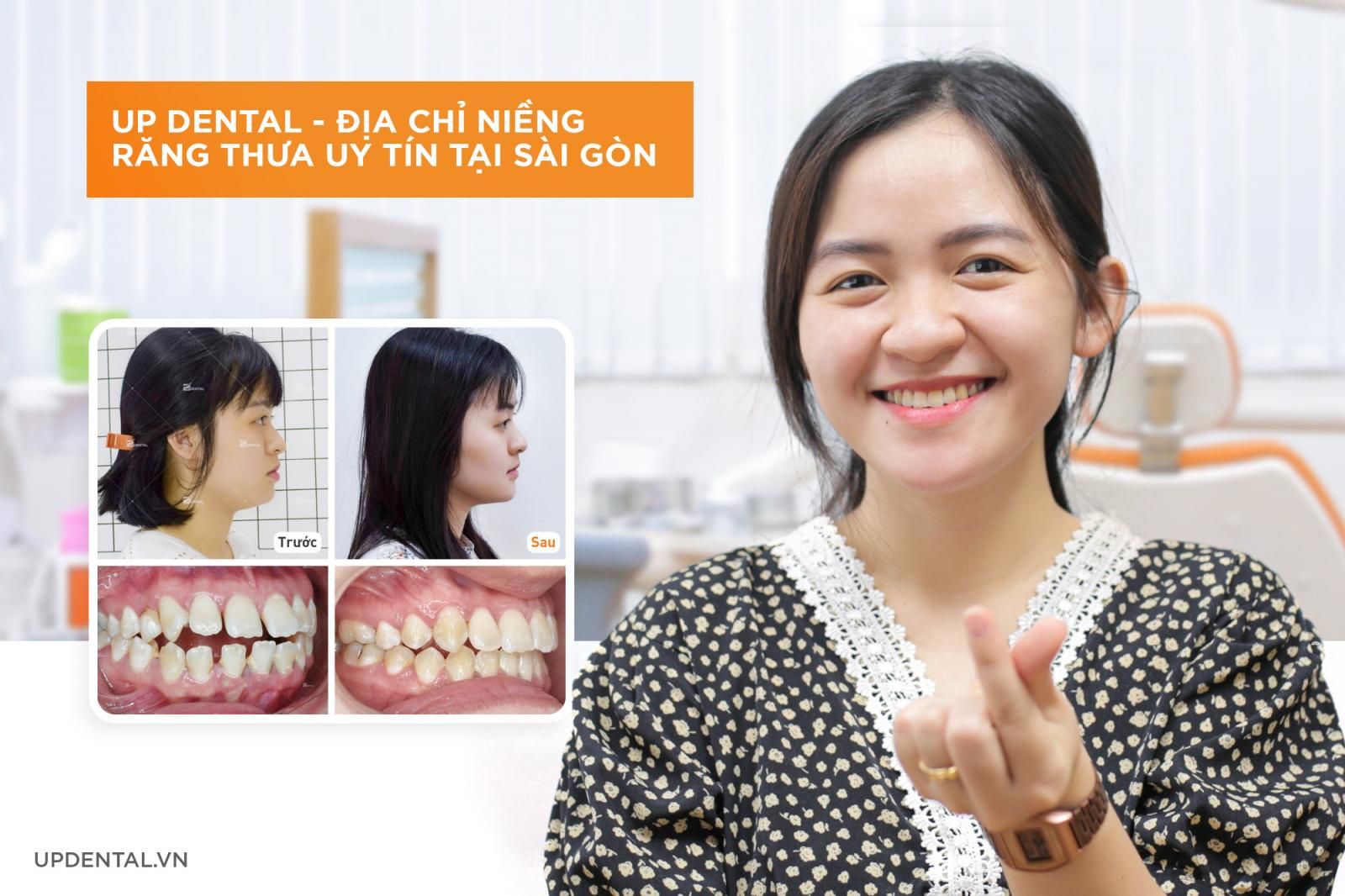 Địa chỉ niềng răng thưa uy tín