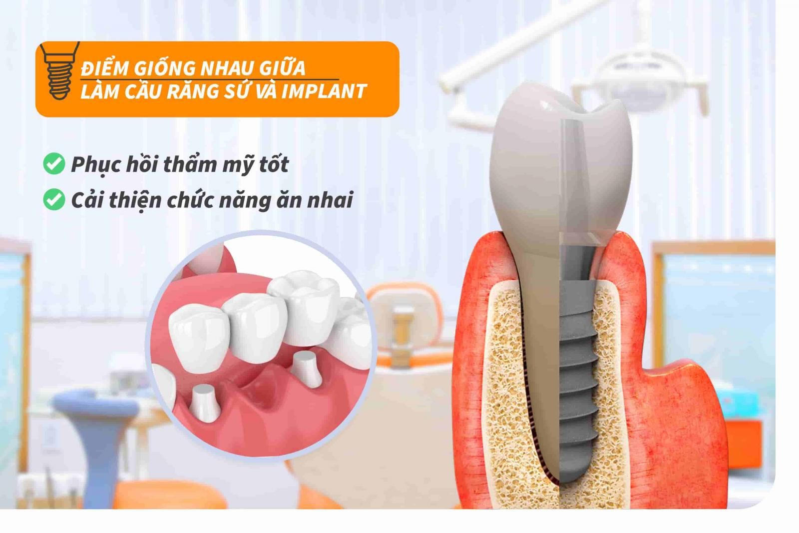 Điểm giống nhau giữa cầu răng sứ và Implant