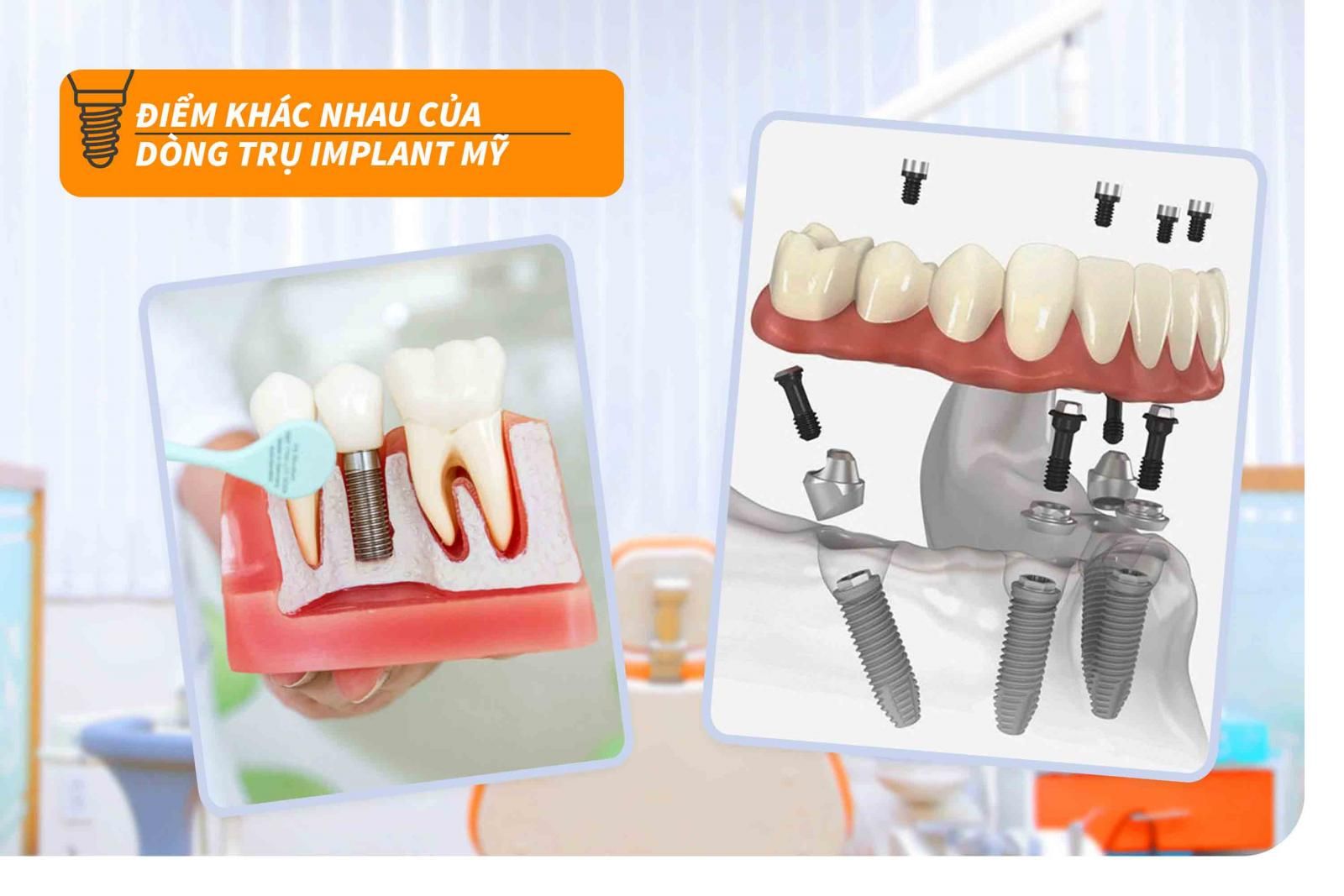 Đặc điểm khác nhau của các dòng trụ Implant Mỹ