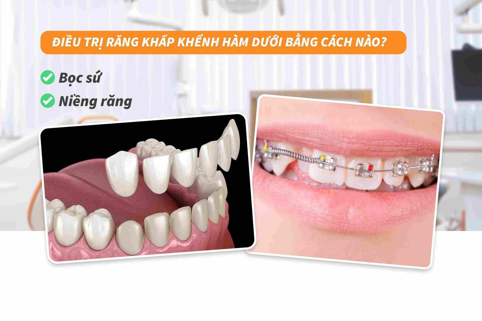 Điều trị răng khấp khểnh hàm dưới bằng cách nào? 