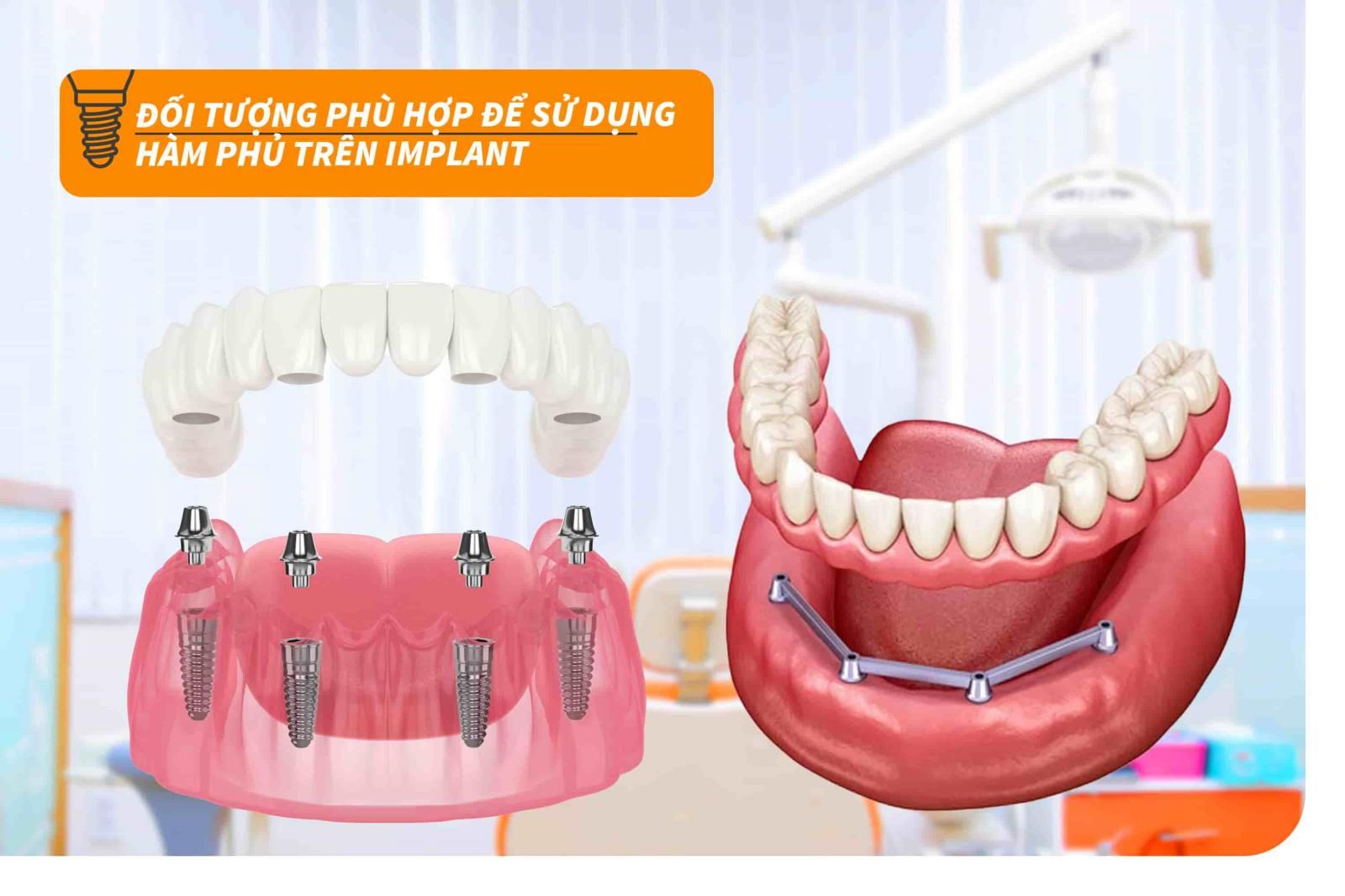 Đối tượng phù hợp để sử dụng hàm phủ trên Implant