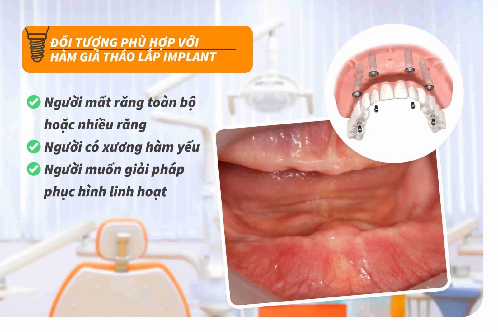 Đối tượng phù hợp với hàm giả tháo lắp Implant