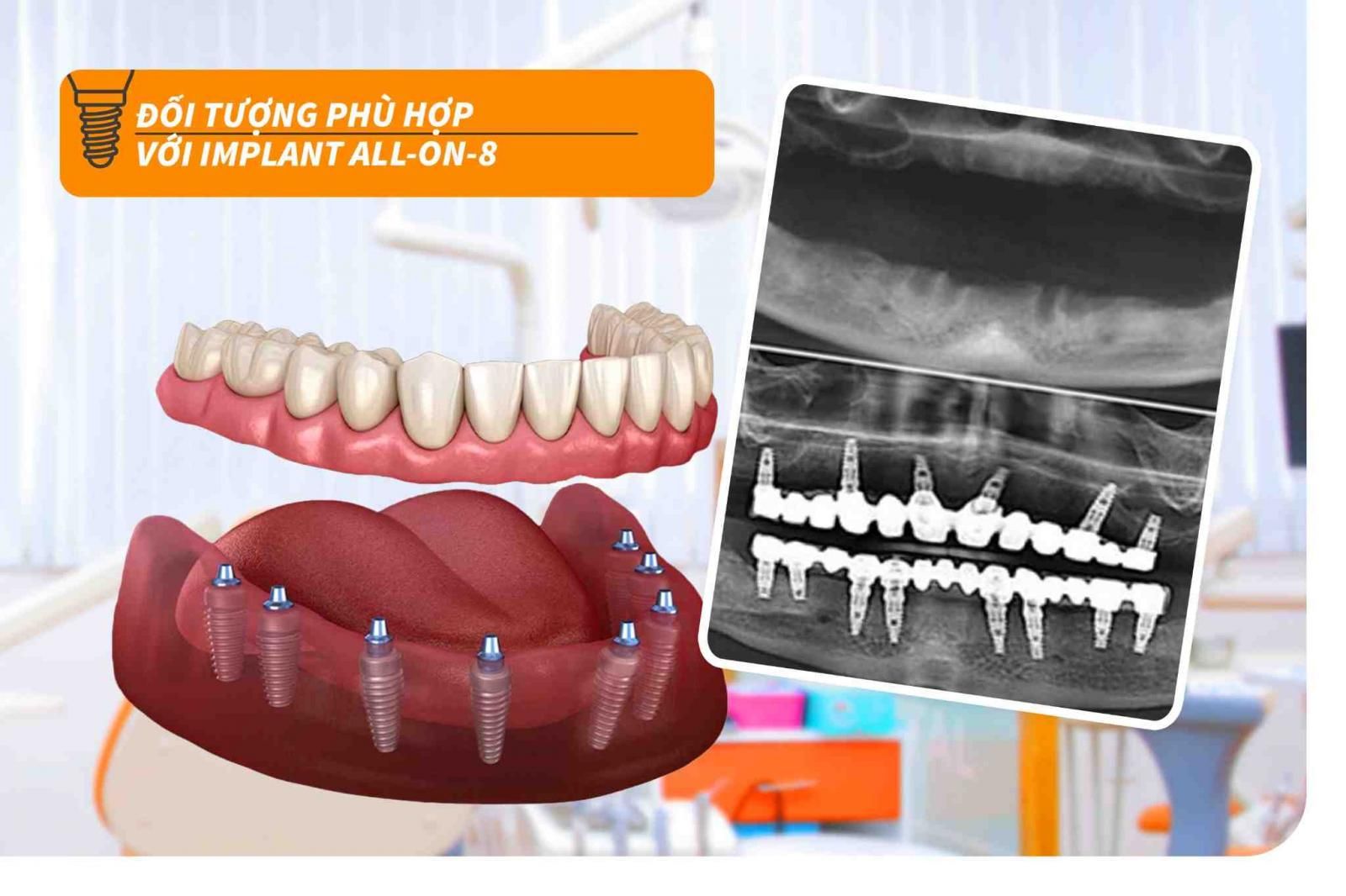 Đối tượng phù hợp với Implant All-on-8