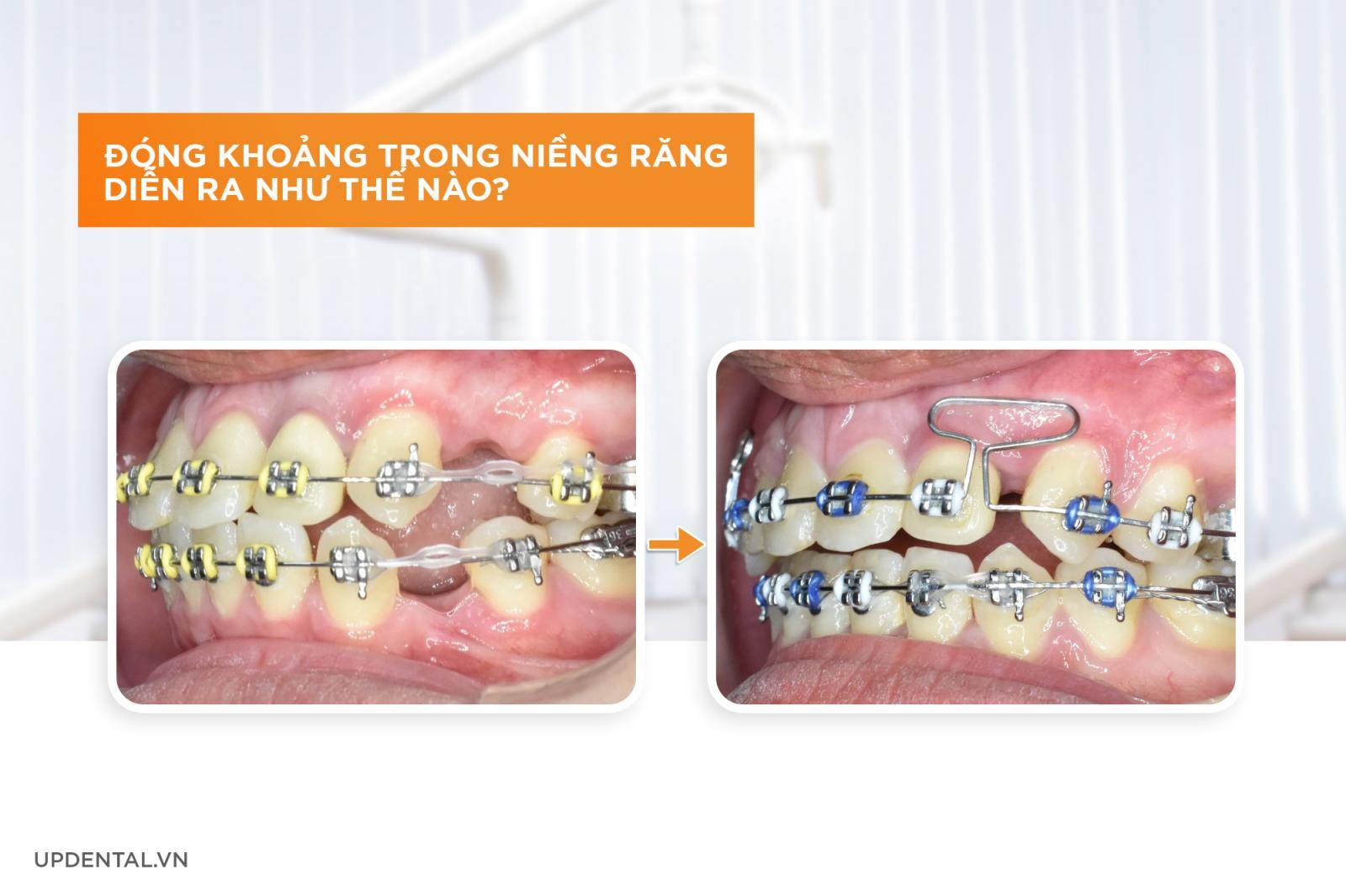 Đóng khoảng niềng răng diễn ra như thế nào?