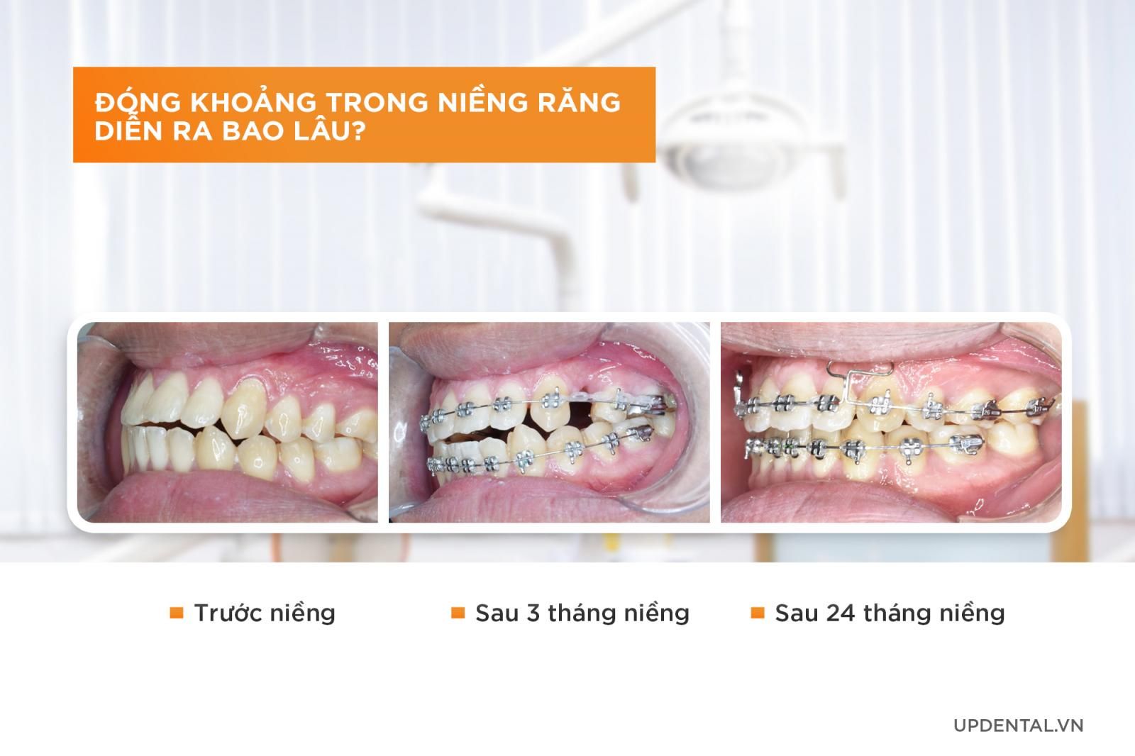 đóng khoảng trong niềng răng diễn ra bao lâu