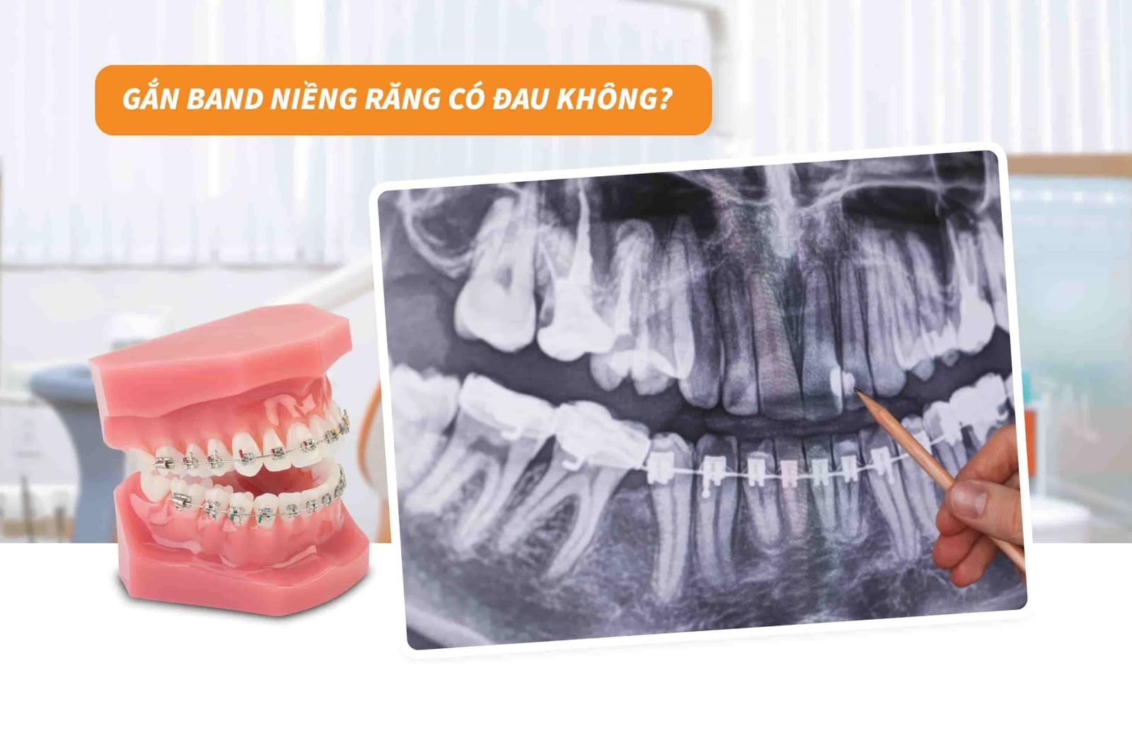 Gắn band niềng răng có đau không? 