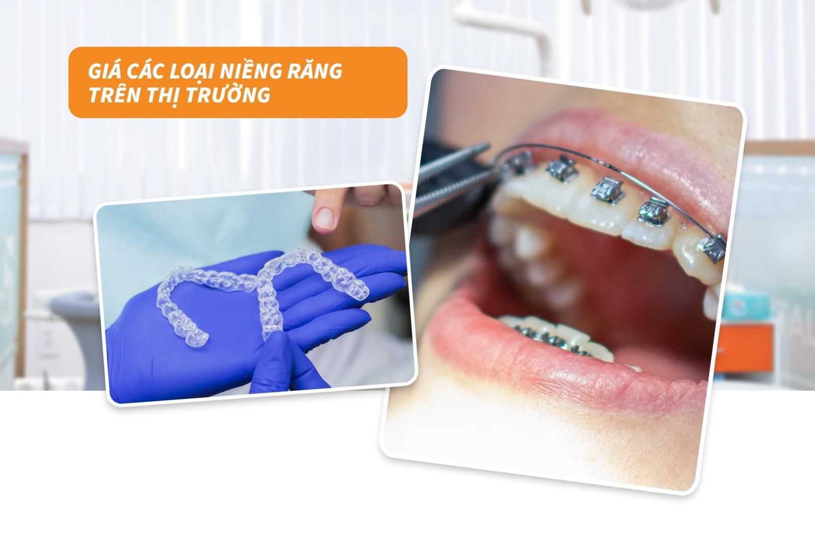 giá các loại niềng răng trên thị trường