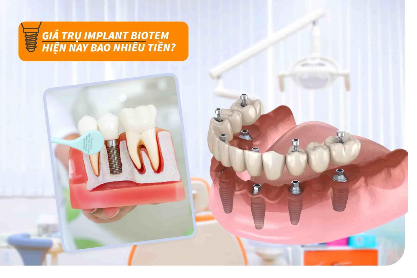 Giá trụ Implant Biotem hiện nay